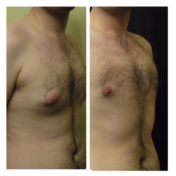 Gynecomastia Surgery in Turkey